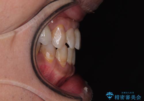 今からでも綺麗な歯並びを手に入れたい 40代男性のワイヤー矯正の治療後