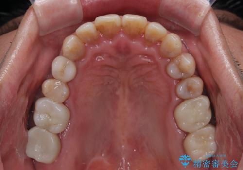 今からでも綺麗な歯並びを手に入れたい 40代男性のワイヤー矯正の治療後