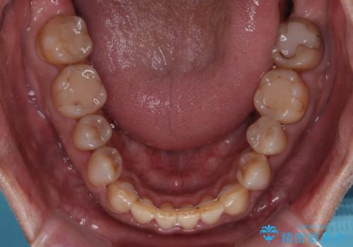 今からでも綺麗な歯並びを手に入れたい 40代男性のワイヤー矯正の治療後