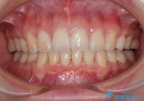 飛び出した上顎前歯 抜歯矯正でスッキリとした横顔にの症例 治療後