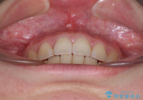 飛び出した上顎前歯 抜歯矯正でスッキリとした横顔にの治療後