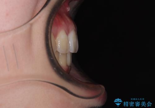 飛び出した上顎前歯 抜歯矯正でスッキリとした横顔にの治療後