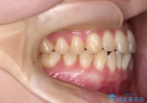 【インビザライン、10ヵ月で矯正終了!】下の前歯が斜めになっているのを治したい!の治療前