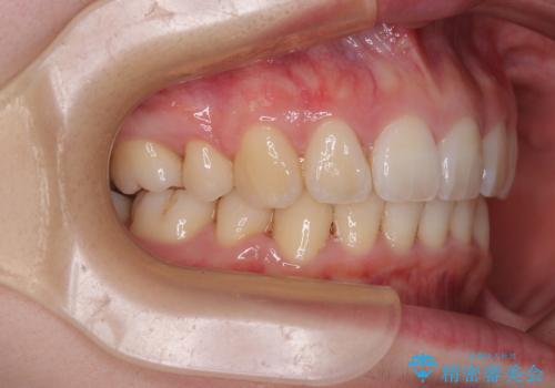 飛び出した上顎前歯 抜歯矯正でスッキリとした横顔にの治療後