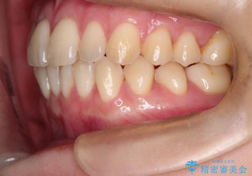 【インビザライン、10ヵ月で矯正終了!】下の前歯が斜めになっているのを治したい!の治療前