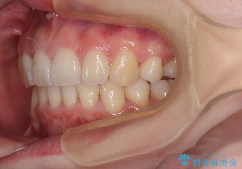 飛び出した上顎前歯 抜歯矯正でスッキリとした横顔にの治療後