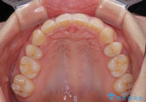 飛び出した上顎前歯 抜歯矯正でスッキリとした横顔にの治療後
