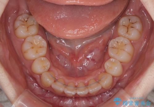 飛び出した上顎前歯 抜歯矯正でスッキリとした横顔にの治療後