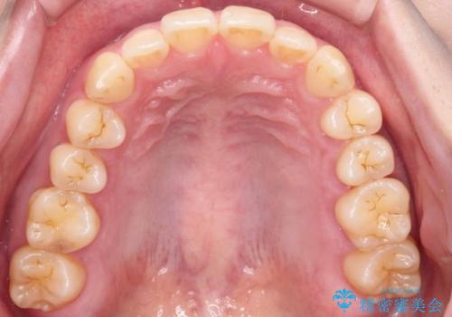 【インビザライン、10ヵ月で矯正終了!】下の前歯が斜めになっているのを治したい!の治療前