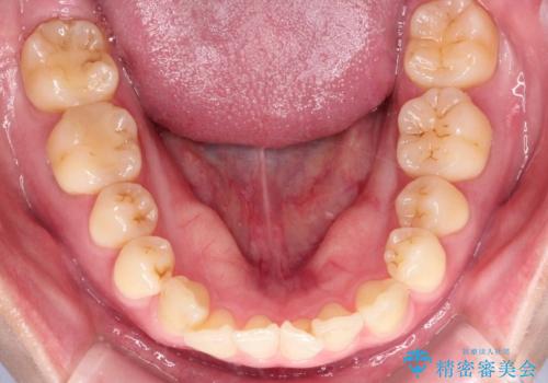 【インビザライン、10ヵ月で矯正終了!】下の前歯が斜めになっているのを治したい!の治療前