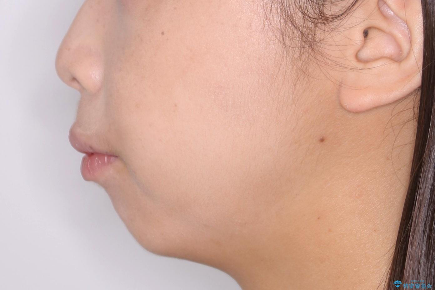 【抜歯】ワイヤー装置で綺麗な歯並び!口元も劇的変化の治療前(顔貌)