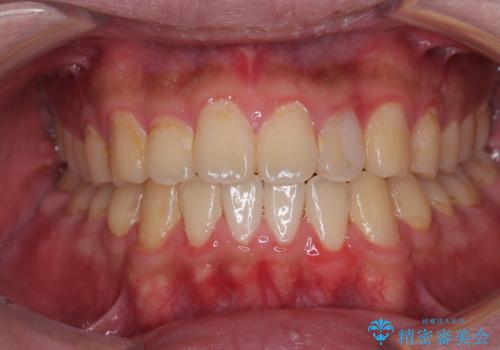 クロスバイトを楽して治す ワイヤー装置にて矯正治療の治療後