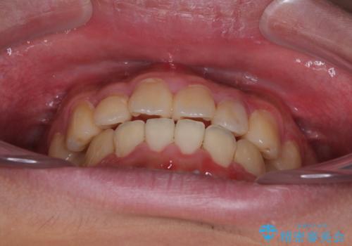 クロスバイトを楽して治す ワイヤー装置にて矯正治療の治療後