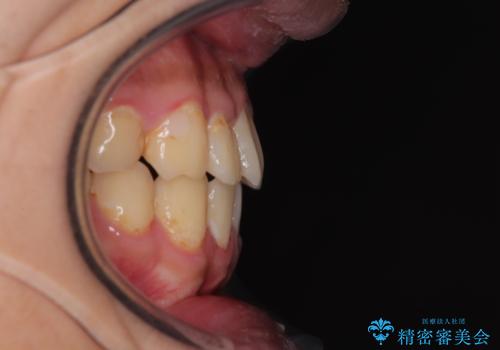 クロスバイトを楽して治す ワイヤー装置にて矯正治療の治療後