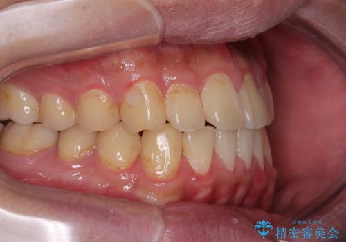 クロスバイトを楽して治す ワイヤー装置にて矯正治療の治療後