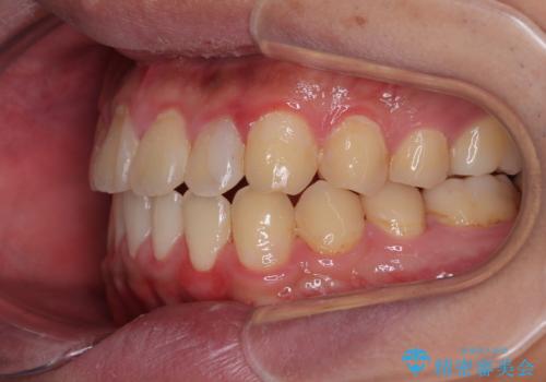 クロスバイトを楽して治す ワイヤー装置にて矯正治療の治療後