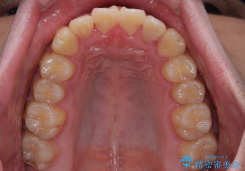 クロスバイトを楽して治す ワイヤー装置にて矯正治療の治療後