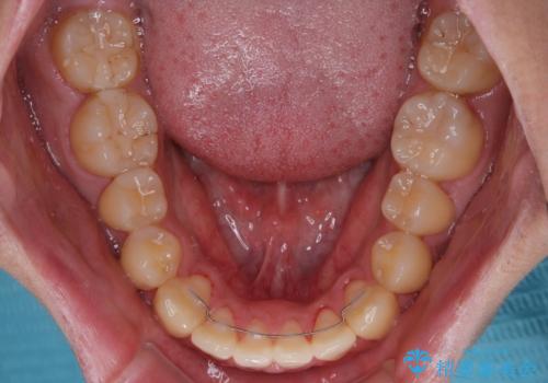 クロスバイトを楽して治す ワイヤー装置にて矯正治療の治療後