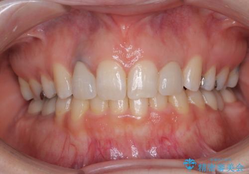 飛び出した上顎前歯とむし歯の多い歯列　目立たないハーフリンガル矯正とむし歯治療の症例 治療後