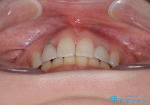飛び出した上顎前歯とむし歯の多い歯列　目立たないハーフリンガル矯正とむし歯治療の治療後