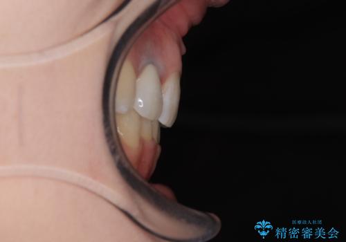 飛び出した上顎前歯とむし歯の多い歯列 目立たないハーフリンガル矯正とむし歯治療の治療後