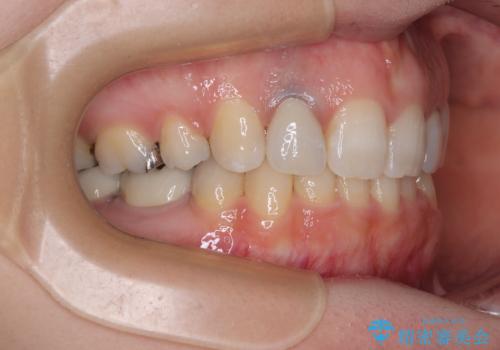 飛び出した上顎前歯とむし歯の多い歯列 目立たないハーフリンガル矯正とむし歯治療の治療後