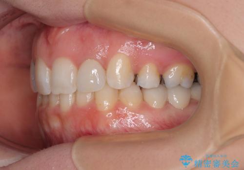 飛び出した上顎前歯とむし歯の多い歯列 目立たないハーフリンガル矯正とむし歯治療の治療後