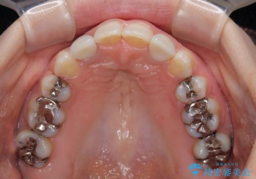 飛び出した上顎前歯とむし歯の多い歯列 目立たないハーフリンガル矯正とむし歯治療の治療後