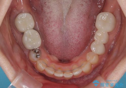 飛び出した上顎前歯とむし歯の多い歯列　目立たないハーフリンガル矯正とむし歯治療の治療後