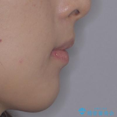 飛び出した上顎前歯とむし歯の多い歯列 目立たないハーフリンガル矯正とむし歯治療の治療後(顔貌)