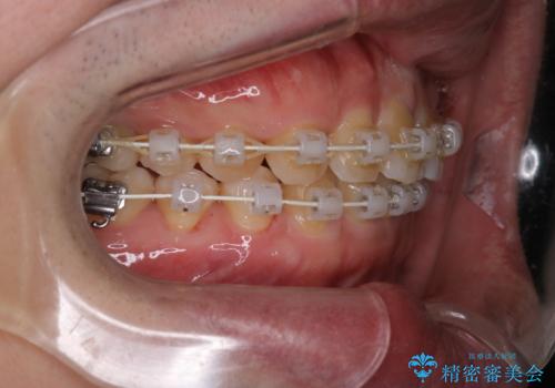 【審美装置】前歯をきれいにしたいの治療中