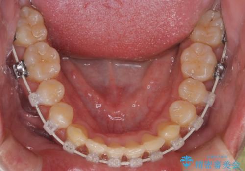 【審美装置】前歯をきれいにしたいの治療中