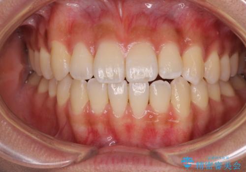 八重歯とオープンバイト　急速拡大装置を用いた矯正治療の症例 治療後