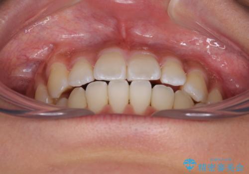 八重歯とオープンバイト 急速拡大装置を用いた矯正治療の治療後