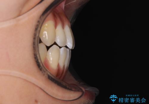 八重歯とオープンバイト 急速拡大装置を用いた矯正治療の治療後