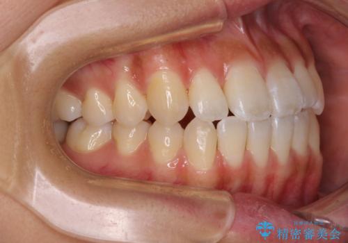 八重歯とオープンバイト　急速拡大装置を用いた矯正治療の治療後