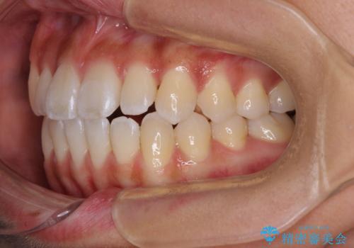 八重歯とオープンバイト　急速拡大装置を用いた矯正治療の治療後