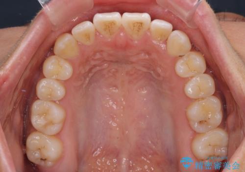 八重歯とオープンバイト 急速拡大装置を用いた矯正治療の治療後