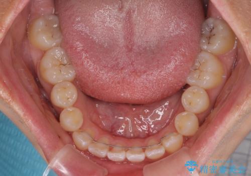 八重歯とオープンバイト 急速拡大装置を用いた矯正治療の治療後