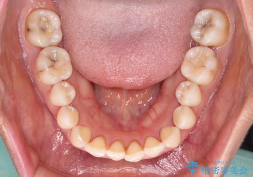 隙間をセラミックで閉じたら不格好で歯肉から出血 矯正治療と歯周外科で綺麗な前歯にの治療前