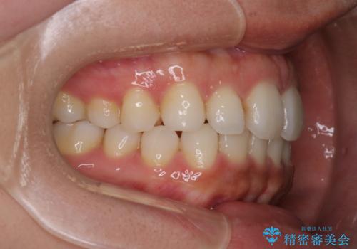 【インビザライン】前歯の後戻りを再矯正の治療後