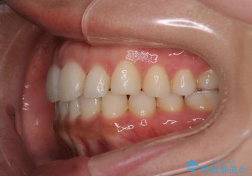 【インビザライン】前歯の後戻りを再矯正の治療後