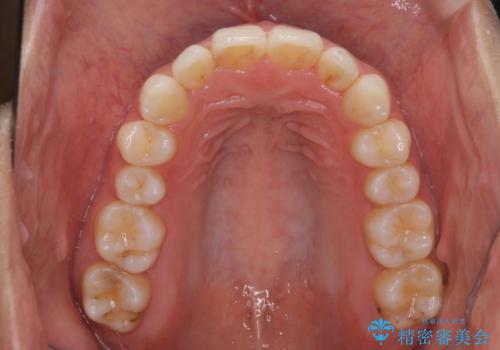 【インビザライン】前歯の後戻りを再矯正の治療後