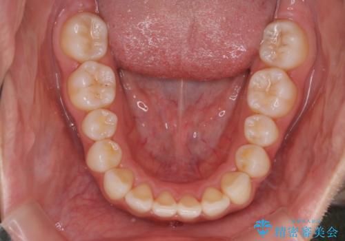 【インビザライン】前歯の後戻りを再矯正の治療後