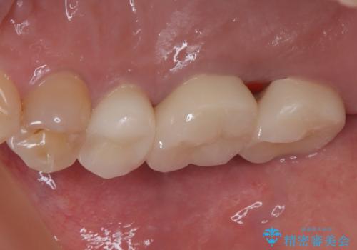 不快感の強い奥歯 オールセラミッククラウンでのむし歯治療の治療後