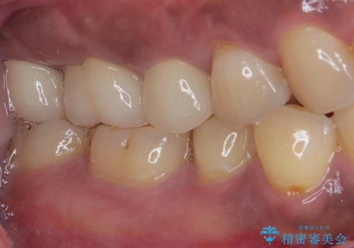 不快感の強い奥歯 オールセラミッククラウンでのむし歯治療の治療後