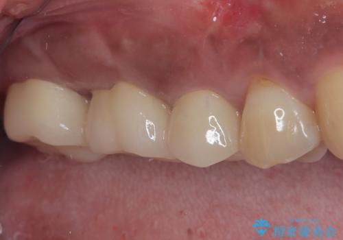 不快感の強い奥歯 オールセラミッククラウンでのむし歯治療の治療後