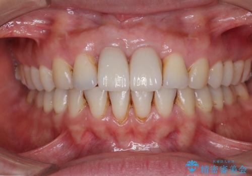 隙間をセラミックで閉じたら不格好で歯肉から出血 矯正治療と歯周外科で綺麗な前歯にの治療後
