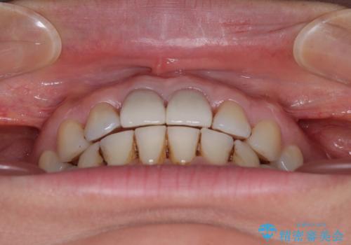 隙間をセラミックで閉じたら不格好で歯肉から出血　矯正治療と歯周外科で綺麗な前歯にの治療後