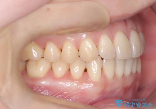 【インビザライン、10ヵ月で矯正終了!】下の前歯が斜めになっているのを治したい!の治療後